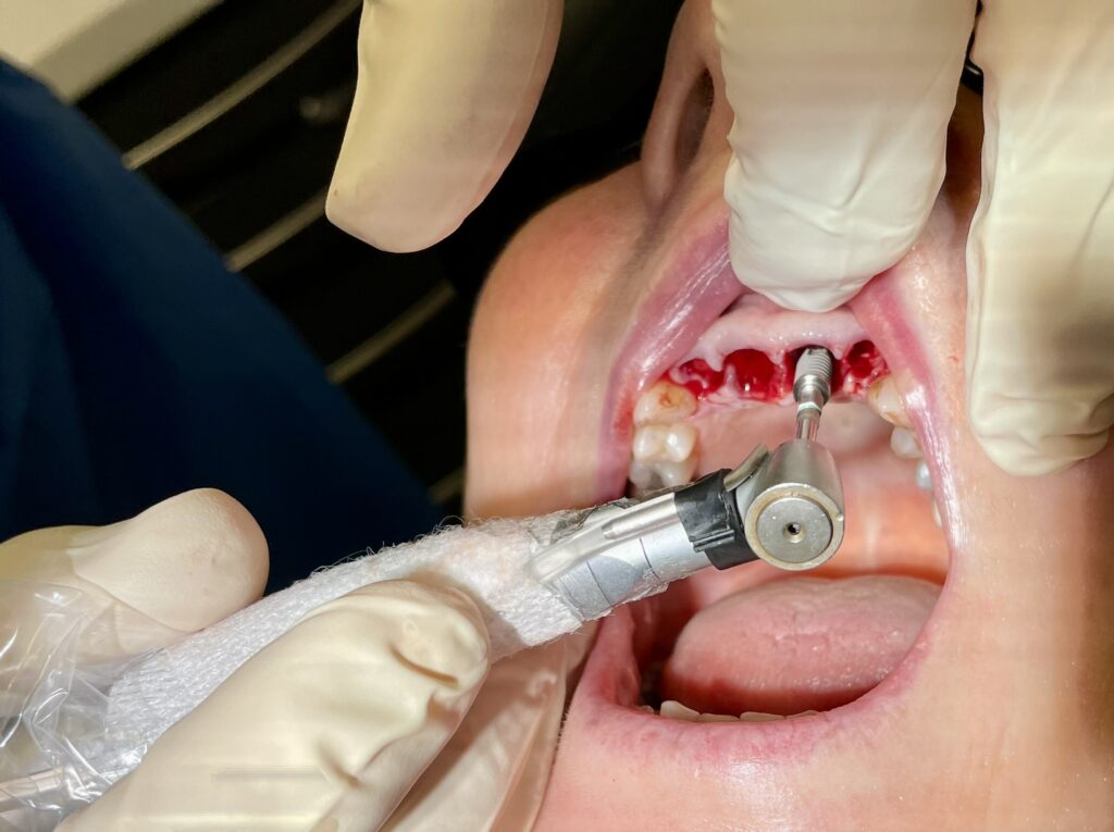 Dental implant being placed immediately after extraction of the upper front teeth