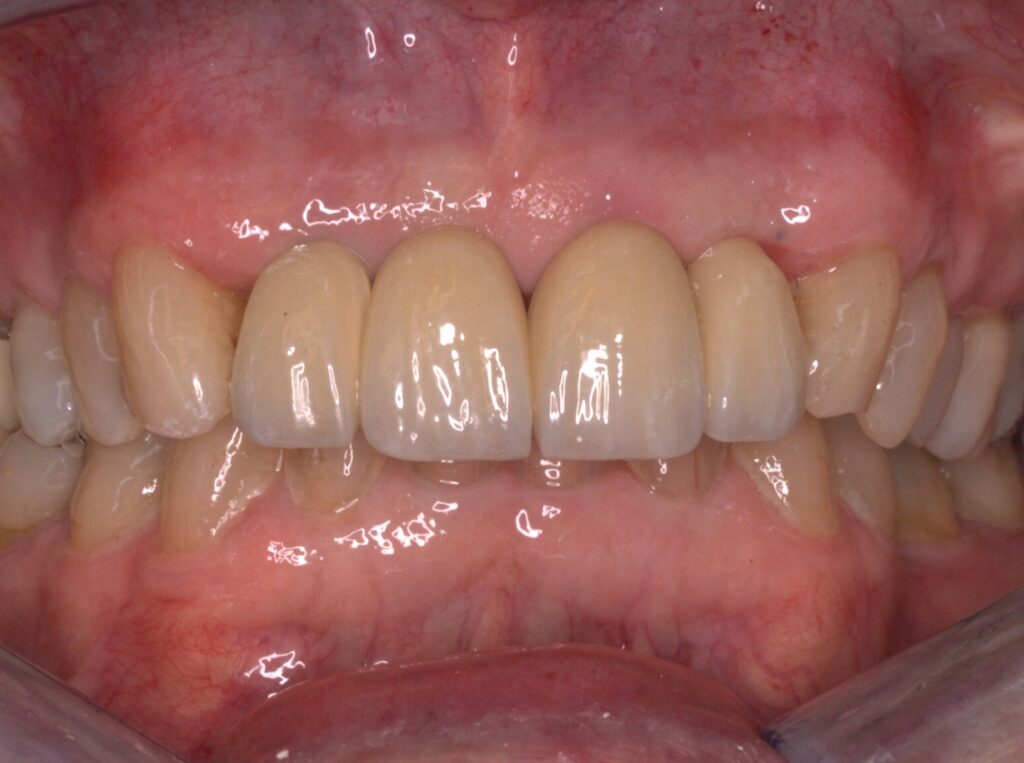 Close-up of the upper front teeth restored on dental implants, two years after treatment