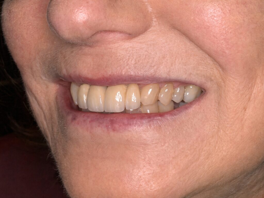 Patient smiling two years after immediate dental implant treatment on the upper front teeth