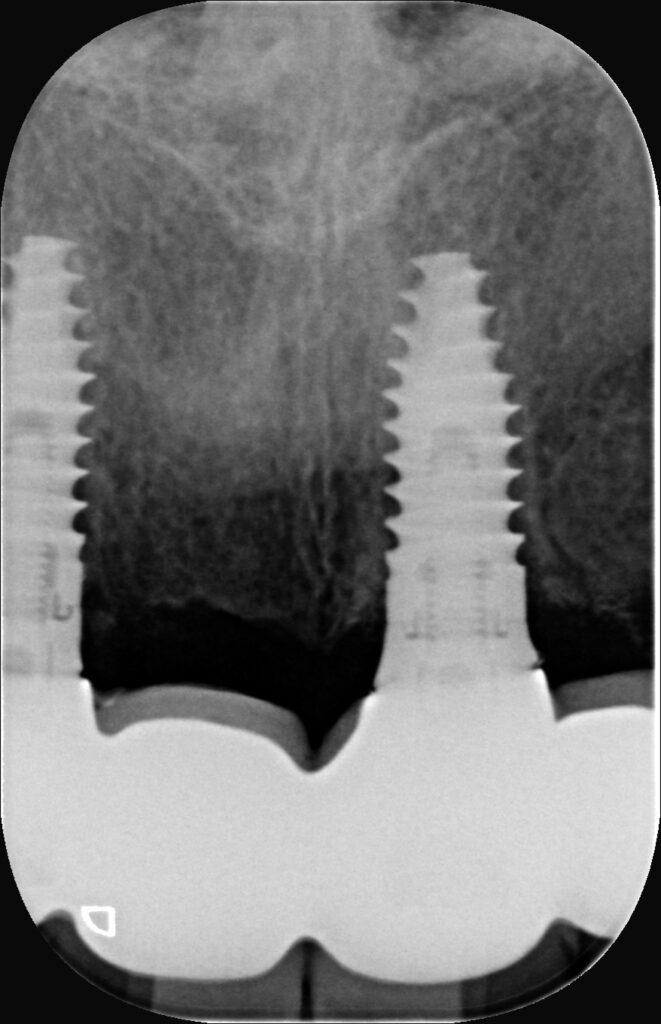 Dental X-ray showing two implants well integrated with the bone, two years after placement