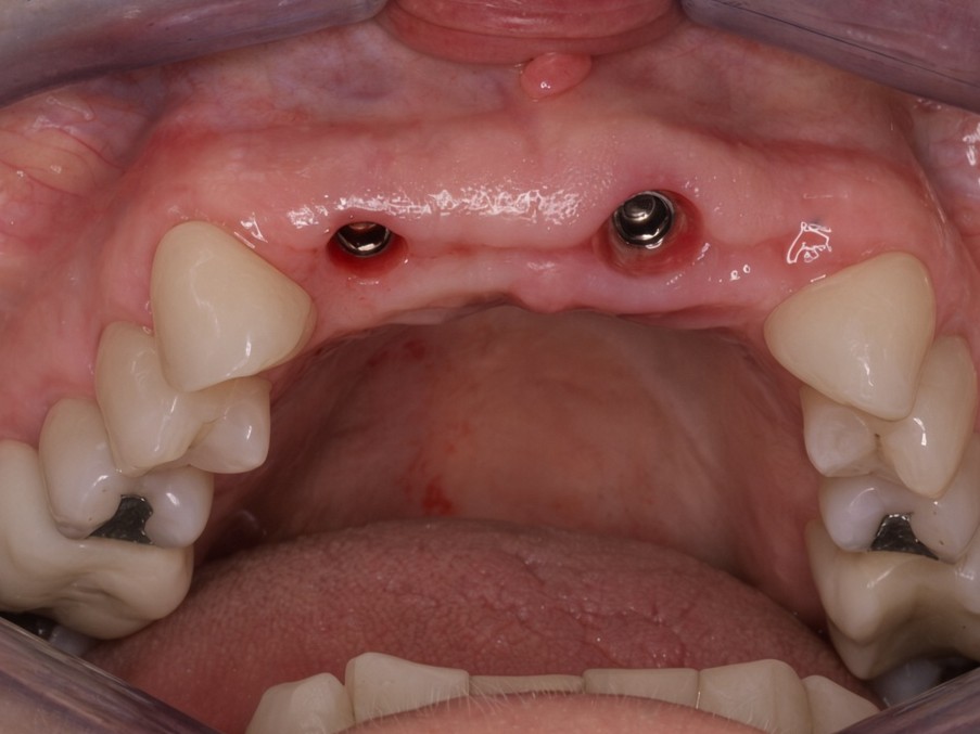 Two healed dental implants in the upper front jaw with healthy gum tissue